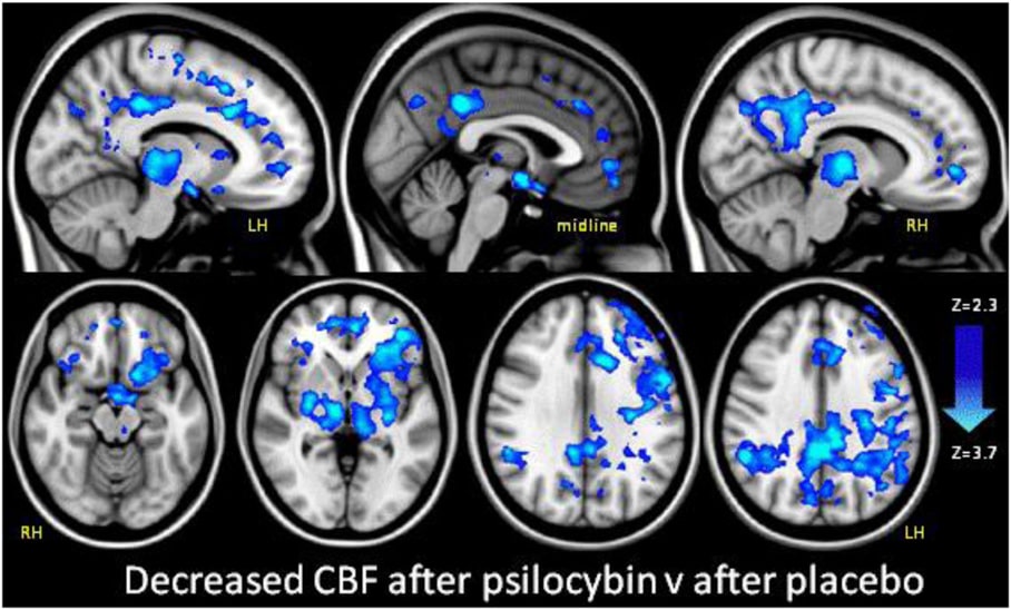 this is your brain when you take psilocybin 